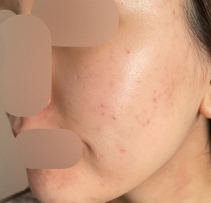 GSD フォトフェイシャル シミ・肝斑治療✨ フォトフェイシャル（ステラM22）2回＋ エレクトロポ