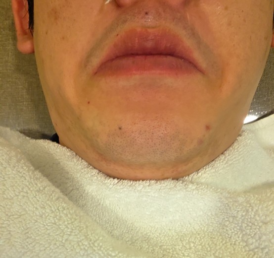 before photo: 아쿠아필링, 수염제모