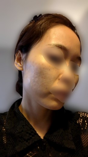 after photo: 脂肪溶解注射(腕), 脂肪溶解注射(太もも)