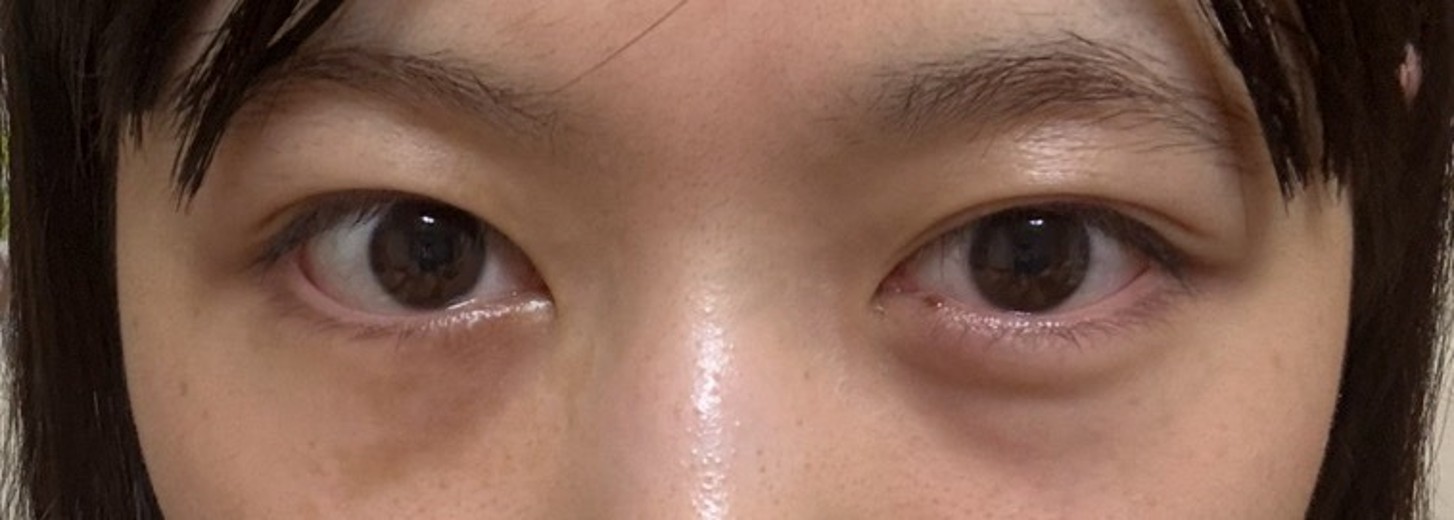 after photo: 目の下脂肪再配置(ハムラ・裏ハムラ法)
