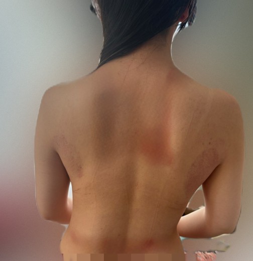 after photo: 脂肪冷却(背中)