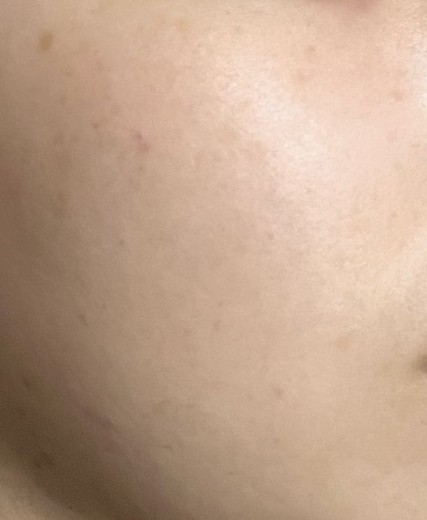 after photo: 白玉注射・点滴