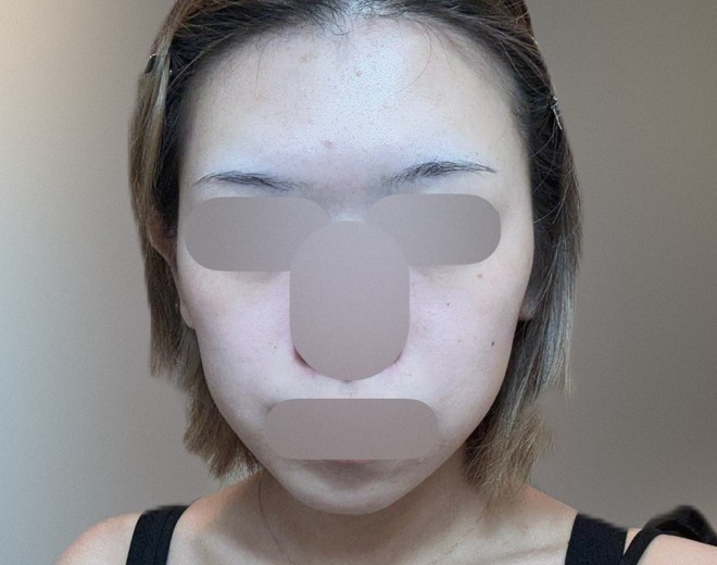 after photo: IPL(光/フォト治療)