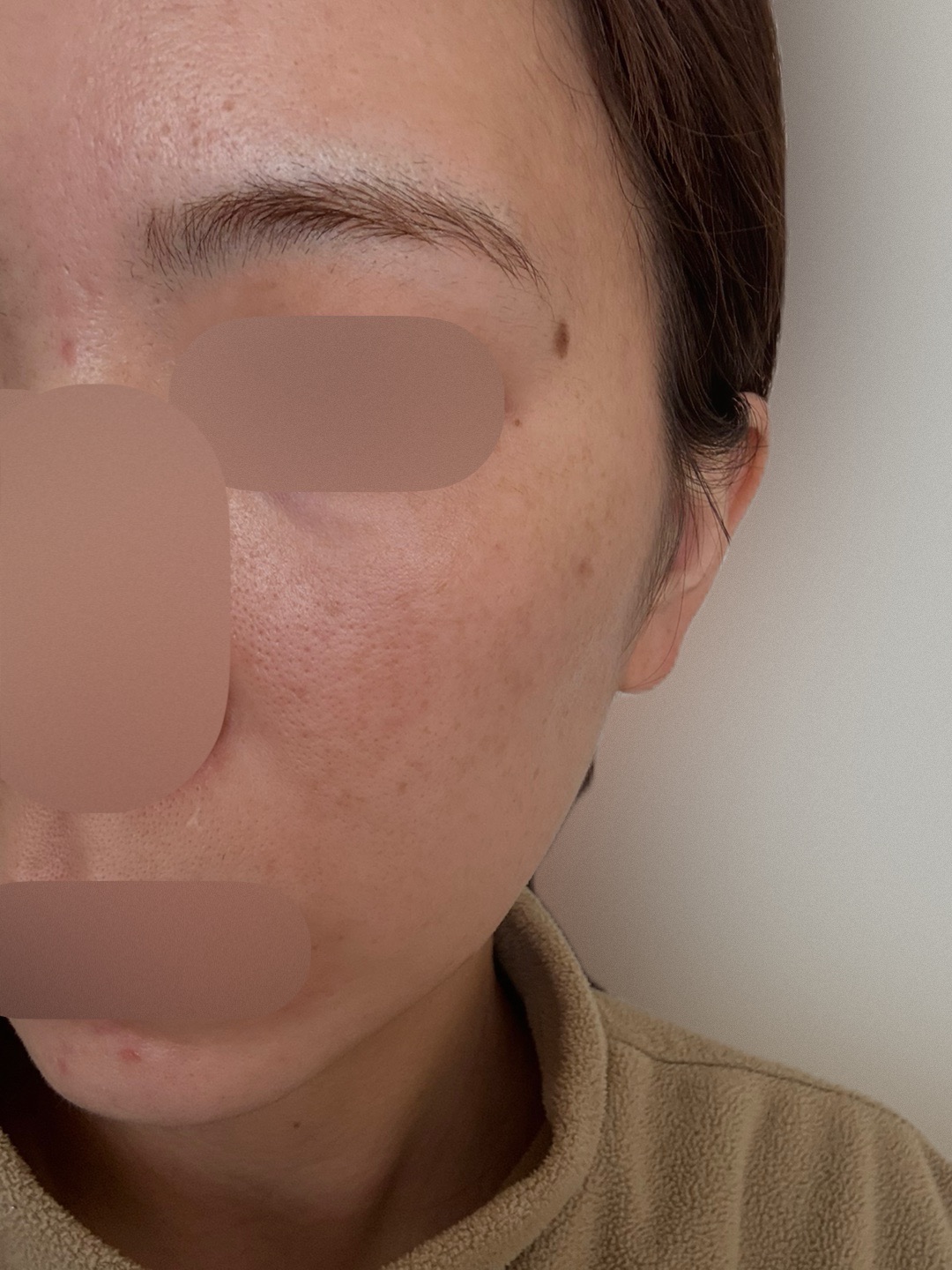 IPL（光治療）全顔2周 ｜ステラM22フォトフェイシャル【3月15日迄にご