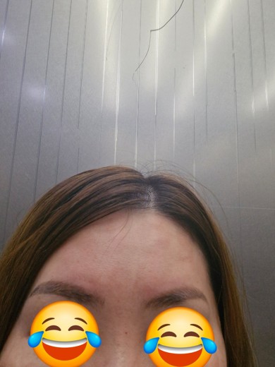 after photo: 이마주름보톡스