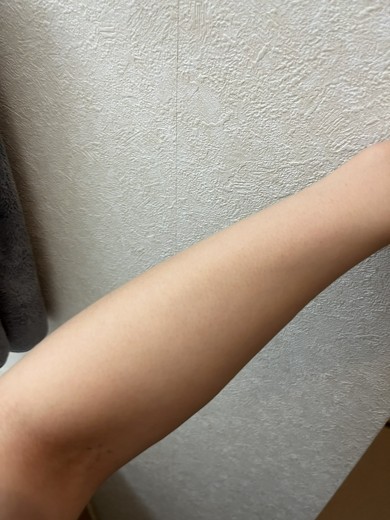 before photo: 白玉注射・点滴