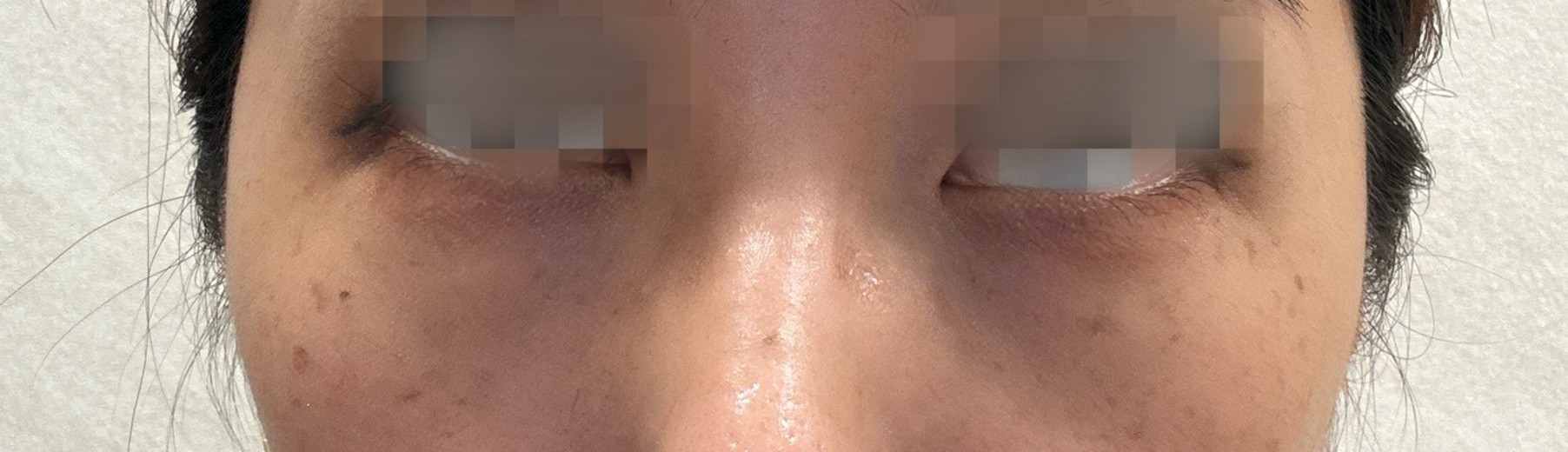 before photo: 目の下の脂肪注入(クマ治療)
