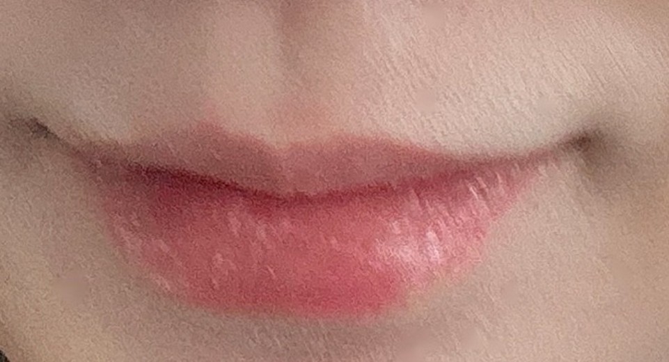 after photo: 입술필러