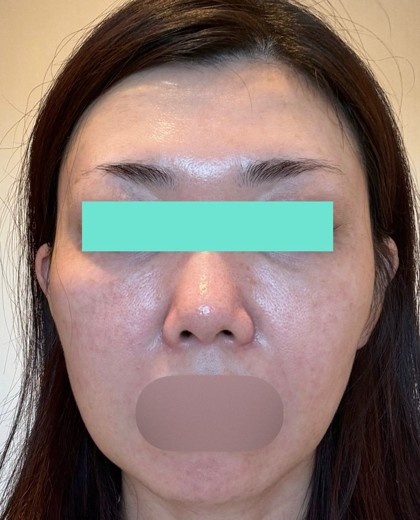 before photo: IPL(光/フォト治療), ルメッカ