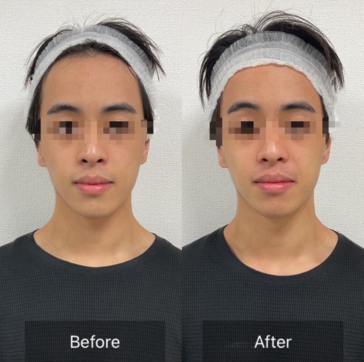 after photo: チタニウムリフト