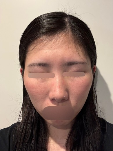 after photo: ヴェルベットスキン