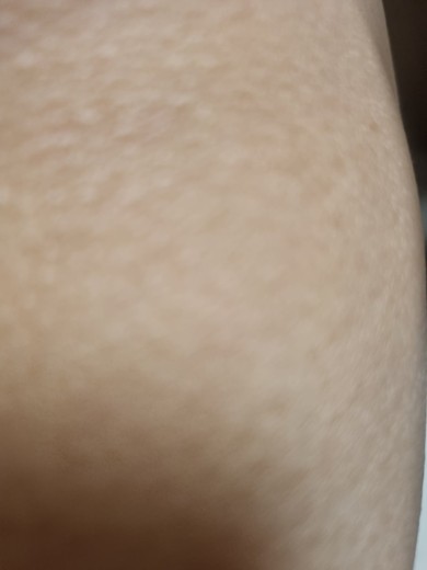 after photo: 이마필러