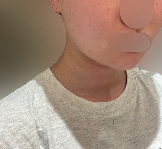 before photo: 脂肪吸引注射