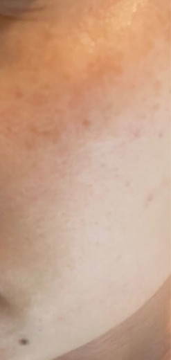 after photo: レーザーフェイシャル