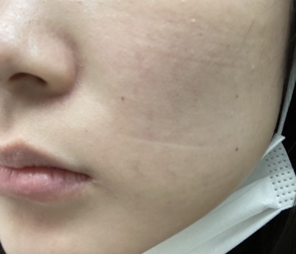 after photo: ルメッカ