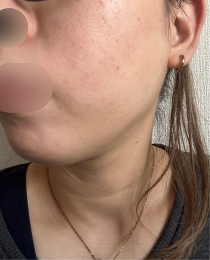 after photo: レーザーフェイシャル