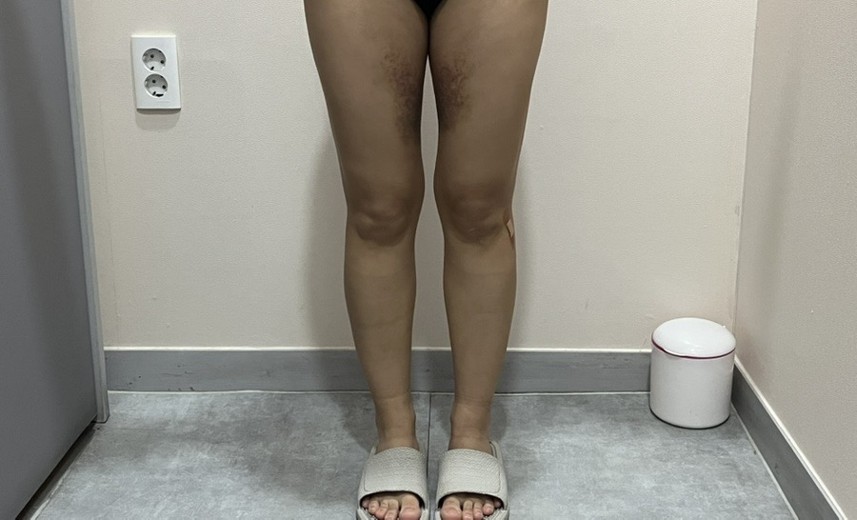 before photo: 복부지방흡입, 아르기닌수액