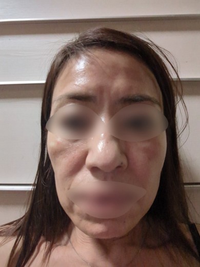 before photo: ハイドラフェイシャル, 診断・検査