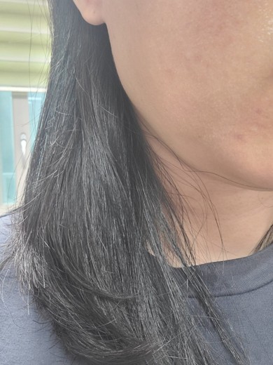 before photo: 온다리프팅