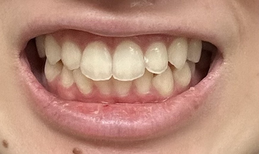 before photo: ホワイトニング