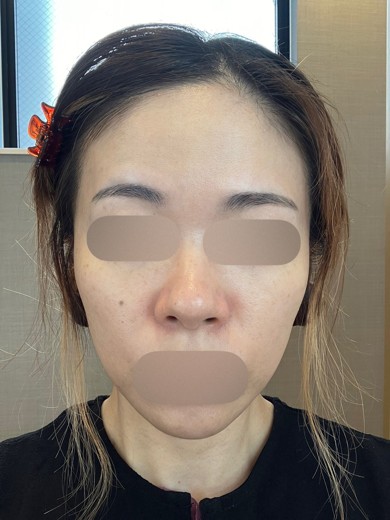 before photo: ピーリング, ルメッカ