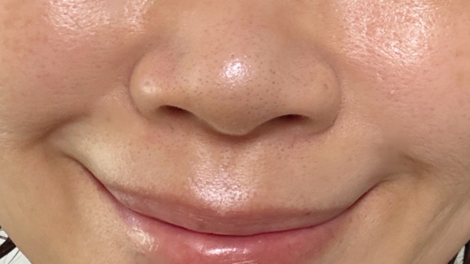 after photo: 小鼻ボトックス, 鼻先ボトックス
