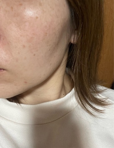 before photo: ピーリング