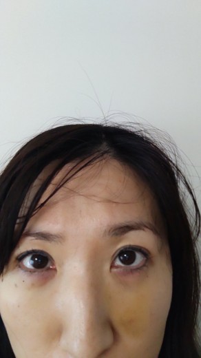 after photo: 脱脂(クマ治療)