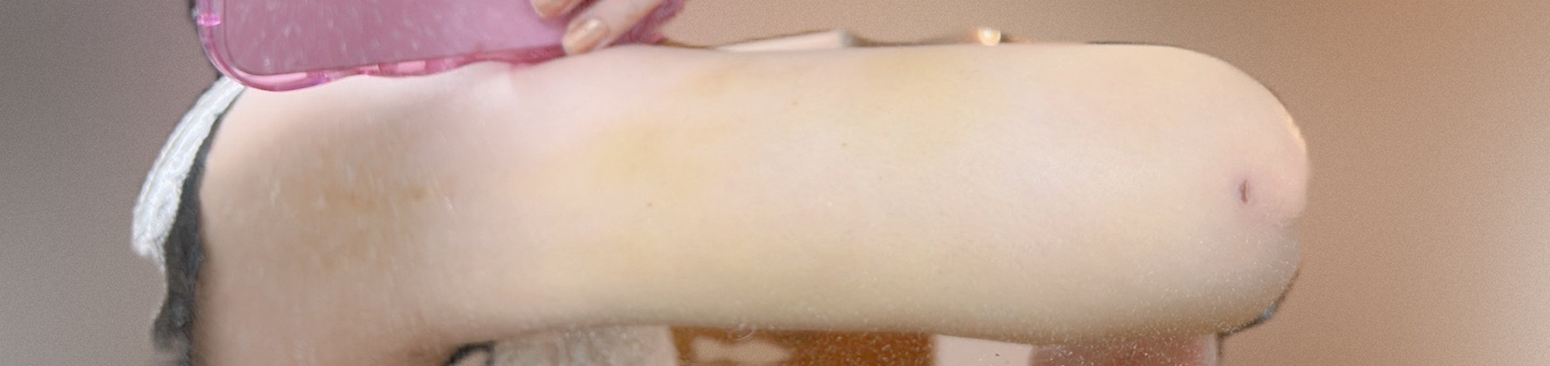 after photo: 脂肪吸引(腕)