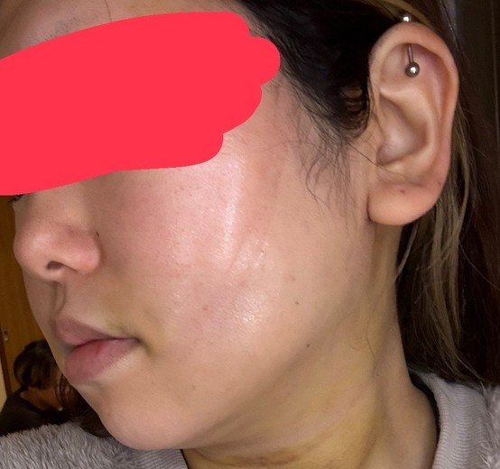 after photo: 糸リフト, 脂肪吸引(顎下), 脂肪吸引(顔), 脂肪吸引(頬)