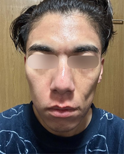 after photo: ダーマペン, エクソソーム