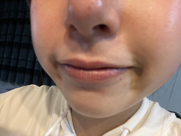 after photo: ダーマペン