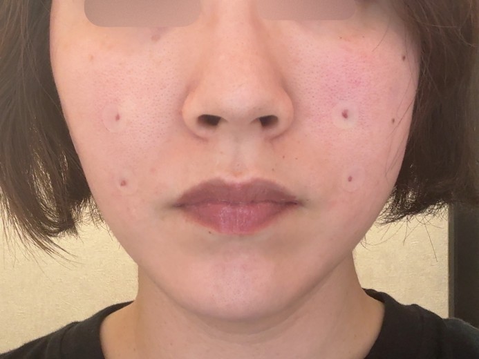 after photo: 糸リフト