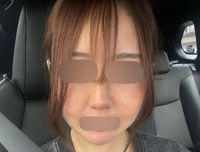 before photo: インモード