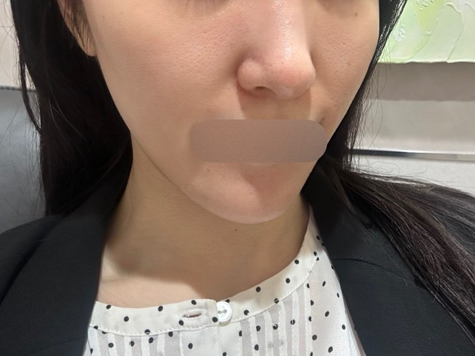 before photo: エレクトロポレーション