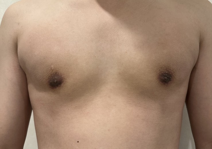 before photo: 여유증수술