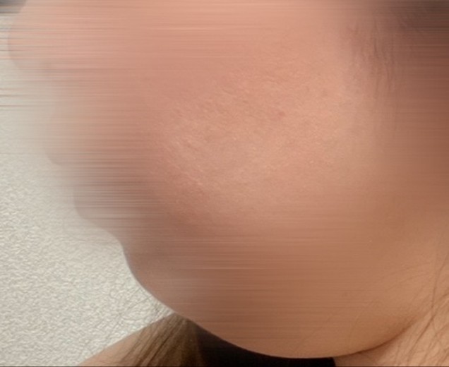 after photo: 脂肪溶解注射(顔)