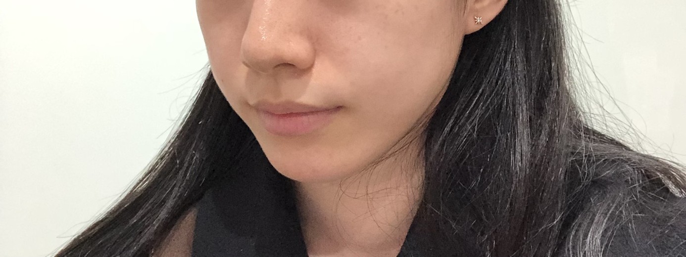 before photo: 입꼬리필러, 입술필러