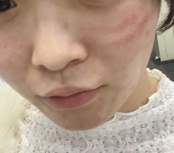 after photo: エレクトロポレーション