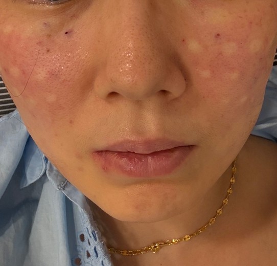 after photo: 스킨보톡스