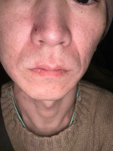 after photo: 糸リフト, 診断・検査