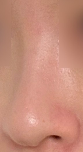 before photo: 콧대(보형물), 코끝(자가연골)