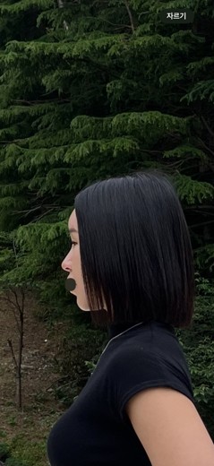 before photo: 콧대(보형물), 코끝(자가연골), 복코교정(수술)