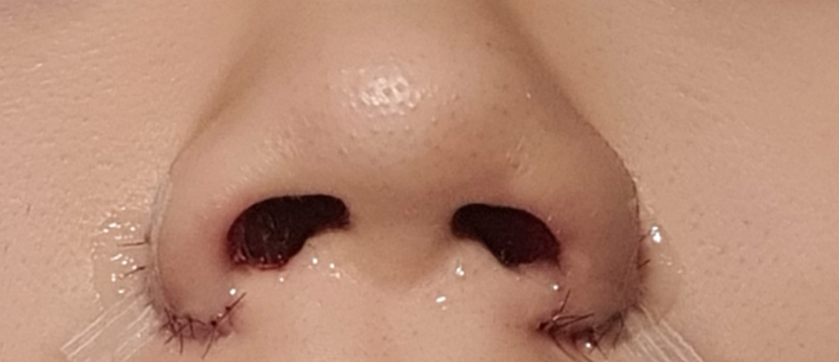 after photo: 콧볼축소