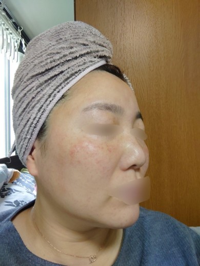 after photo: ダーマペン