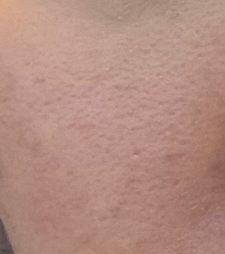 before photo: 아쿠아필링