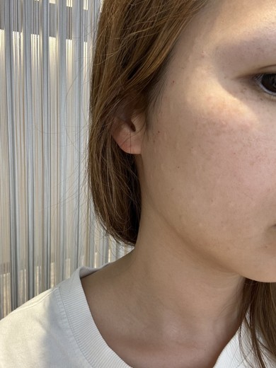 after photo: スキンボトックス