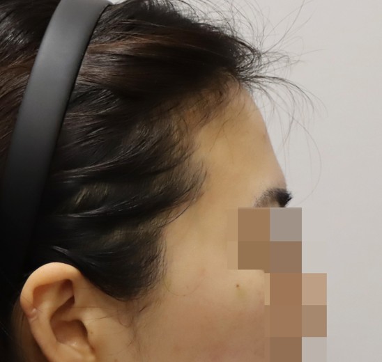 before photo: 이마필러