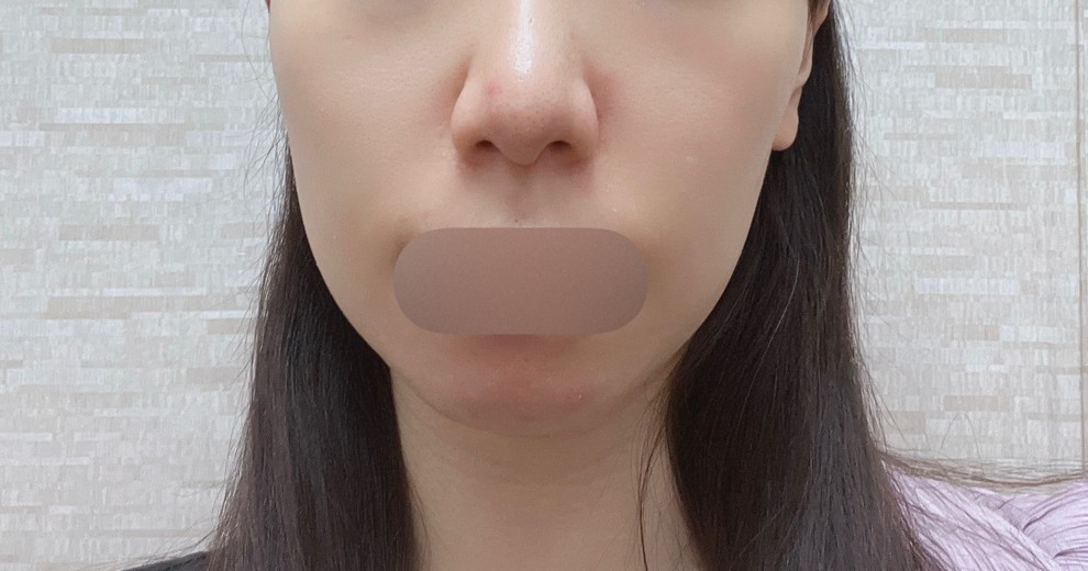 before photo: イオン導入