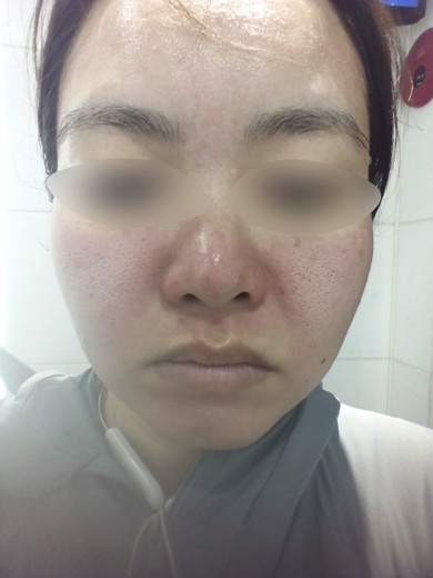 after photo: ダーマペン